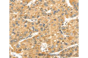 Immunohistochemistry of Human liver cancer using SH3KBP1 Polyclonal Antibody at dilution of 1:40