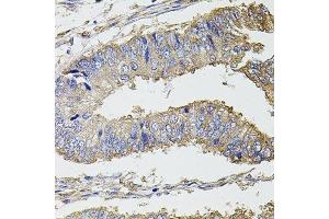 Immunohistochemistry of paraffin-embedded human colon carcinoma using UBE2S antibody. (UBE2S Antikörper  (AA 122-221))