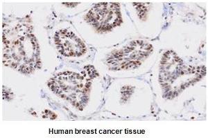 Paraffin embedded sections of human breast cancer tissue were incubated with anti-human PPM1G (1:50) for 2 hours at room temperature. (PPM1G Antikörper)