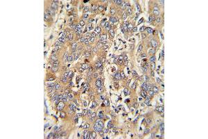 Formalin-fixed and paraffin-embedded human hepatocarcinoma with PIGR Antibody , which was peroxidase-conjugated to the secondary antibody, followed by DAB staining. (Stathmin 1 Antikörper  (C-Term))