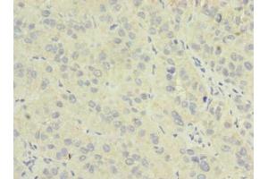 Immunohistochemistry of paraffin-embedded human liver cancer using ABIN7162044 at dilution of 1:100 (NME7 Antikörper  (AA 1-150))