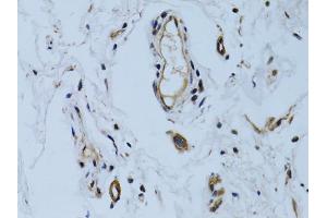 Immunohistochemistry of paraffin-embedded human colon carcinoma using MCAM antibody (ABIN6290150) at dilution of 1:100 (40x lens). (MCAM Antikörper)