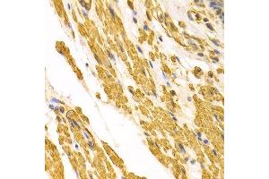 Immunohistochemistry of paraffin-embedded human gastric cancer using CYP2E1 antibody at dilution of 1:100 (x400 lens). (CYP2E1 Antikörper)