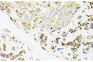Immunohistochemistry of paraffin-embedded Human lung cancer using IRF1 Polyclonal Antibody (IRF1 Antikörper)