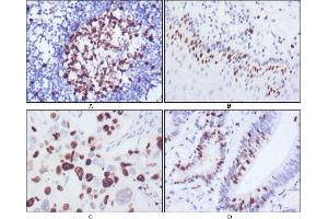 Immunohistochemical analysis of paraffin-embedded human lymph node (A), esophagus (B), lung cancer (C), rectum cancer (D), showing nuclear localization using KI67 antibody with DAB staining. (Ki-67 Antikörper)