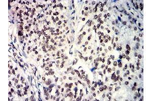 Immunohistochemical analysis of paraffin-embedded bladder cancer tissues using SOX11 mouse mAb with DAB staining. (SOX11 Antikörper  (AA 1-250))