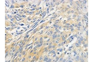 ABIN6259053 and ABIN6274399 at 1/100 staining human lung squamous cell carcinoma by IHC-P.