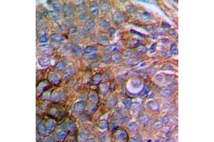 Immunohistochemical analysis of Paxillin staining in human prostate cancer formalin fixed paraffin embedded tissue section. (Paxillin Antikörper  (N-Term))