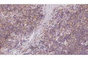 ABIN6273173 at 1/100 staining Human lymph cancer tissue by IHC-P.