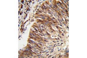 Formalin-fixed and paraffin-embedded human lung carcinoma reacted with ALDH3B1 Antibody (Center), which was peroxidase-conjugated to the secondary antibody, followed by DAB staining. (ALDH3B1 Antikörper  (AA 334-360))