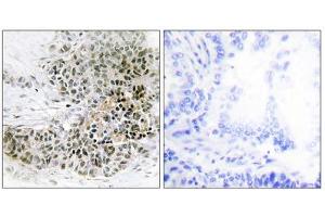 Immunohistochemistry analysis of paraffin-embedded human lung carcinoma tissue, using TRPS1 antibody.