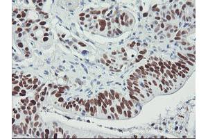 Immunohistochemical staining of paraffin-embedded Carcinoma of Human pancreas tissue using anti-TP53 mouse monoclonal antibody. (p53 Antikörper)