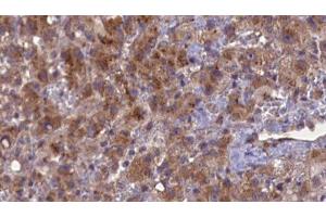 ABIN6276934 at 1/100 staining Human liver cancer tissue by IHC-P. (GABRB2 Antikörper  (N-Term))