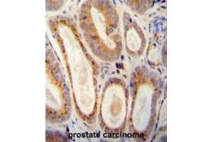 WFDC12 antibody (C-term) immunohistochemistry analysis in formalin fixed and paraffin embedded human prostate carcinoma followed by peroxidase conjugation of the secondary antibody and DAB staining. (WFDC12 Antikörper  (C-Term))