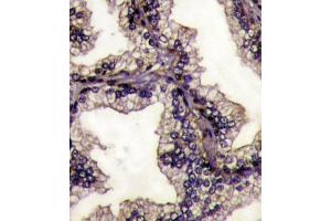 Formalin-fixed and paraffin-embedded prostata carcinoma tissue reacted with LTF Antibody (Center) (ABIN1882099 and ABIN2841775) , which was peroxidase-conjugated to the secondary antibody, followed by DAB staining. (Lactoferrin Antikörper  (AA 219-248))