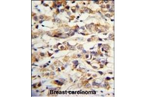 Formalin-fixed and paraffin-embedded human breast carcinoma with KRT14 Antibody (Center), which was peroxidase-conjugated to the secondary antibody, followed by DAB staining. (KRT14 Antikörper  (AA 276-303))