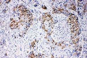 Anti-beta Arrestin 1 antibody, IHC(P) IHC(P): Human Mammary Cancer Tissue (beta Arrestin 1 Antikörper  (N-Term))