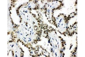Anti-HDAC3 antibody,  IHC(P) IHC(P): Human Lung Cancer Tissue (HDAC3 Antikörper  (C-Term))