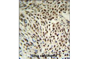 SNRPD3 Antibody IHC analysis in formalin fixed and paraffin embedded human lung carcinoma followed by peroxidase conjugation of the secondary antibody and DAB staining. (SNRPD3 Antikörper  (C-Term))
