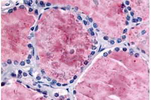 Human Thyroid (formalin-fixed, paraffin-embedded) stained with PDE8B antibody ABIN213536 at 5 ug/ml followed by biotinylated goat anti-rabbit IgG secondary antibody ABIN481713, alkaline phosphatase-streptavidin and chromogen. (PDE8B Antikörper  (Internal Region))