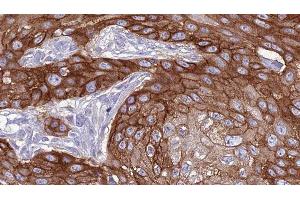 ABIN6277379 at 1/100 staining Human Head and neck cancer tissue by IHC-P. (GRK1 Antikörper  (N-Term))