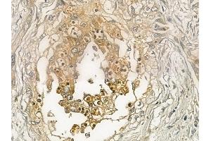 ABIN6262025 and ABIN6272961 at 1/100 staining human cervical carcinoma by IHC-P.