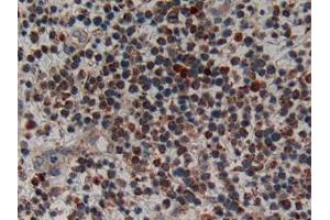 IHC-P analysis of Human Skin cancer Tissue, with DAB staining. (CRH Antikörper  (AA 40-195))
