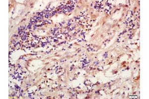 Formalin-fixed and paraffin embedded human lung carcinoma labeled with Anti-TRIB3 Polyclonal Antibody, Unconjugated (ABIN872793) at 1:200 followed by conjugation to the secondary antibody and DAB staining (TRIB3 Antikörper  (AA 201-300))
