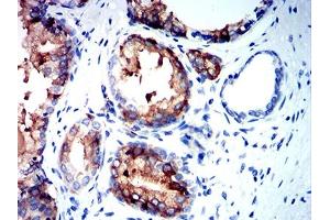 Immunohistochemical analysis of paraffin-embedded prostate cancer tissues using NEFH mouse mAb with DAB staining. (NEFH Antikörper  (AA 2-251))