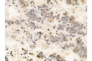 ABIN6265864 and ABIN6266898 at 1/100 staining human melanoma by IHC-P. (UBXN11 Antikörper  (Internal Region))