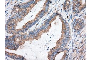 Immunohistochemical staining of paraffin-embedded Adenocarcinoma of Human colon tissue using anti-KHK mouse monoclonal antibody. (Ketohexokinase Antikörper)