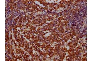 IHC image of ABIN7145214 diluted at 1:100 and staining in paraffin-embedded human lung cancer performed on a Leica BondTM system. (BAG3 Antikörper  (AA 220-420))