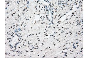 Immunohistochemical staining of paraffin-embedded Adenocarcinoma of breast tissue using anti-NRBP1 mouse monoclonal antibody.