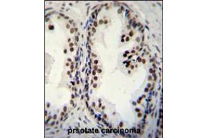 DDX27 Antibody immunohistochemistry analysis in formalin fixed and paraffin embedded human prsotate carcinoma followed by peroxidase conjugation of the secondary antibody and DAB staining. (DDX27 Antikörper  (C-Term))