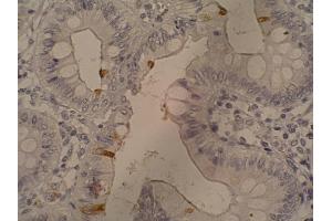 Immunohistochemistry staining of sialyl-Lewis a in colorectal adenocarcinoma (paraffin-embedded sections) with 121SLE antibody. (CA 19-9 Antikörper)