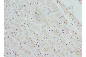 Immunohistochemistry of paraffin-embedded human colon cancer using ABIN7145457 at dilution of 1:100 (CTNNBL1 Antikörper  (AA 264-563))