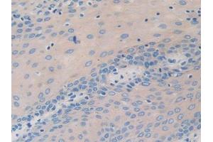 DAB staining on IHC-P; Samples: Human Stomach cancer Tissue