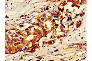 Immunohistochemistry of paraffin-embedded human breast cancer using ABIN7174356 at dilution of 1:100 (USP7 Antikörper  (C-Term))