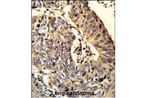 Formalin-fixed and paraffin-embedded human Lung carcinoma reacted with C21orf29 Antibody (Center), which was peroxidase-conjugated to the secondary antibody, followed by DAB staining. (TSPEAR Antikörper  (AA 293-320))