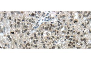 Immunohistochemistry of paraffin-embedded Human breast cancer using TRIM24 Polyclonal Antibody at dilution of 1/40