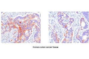 Paraffin embedded sections of human colon canitrocelluloseer tissue were initrocelluloseubated with anti-human Hsp27 (1:50) for 2 hours at room temperature. (HSP27 Antikörper  (AA 1-205))