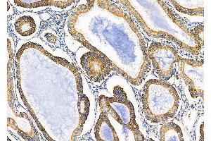 ABIN6257297 and ABIN6275370 at 1/100 staining Human ovarian cancer by IHC-P.
