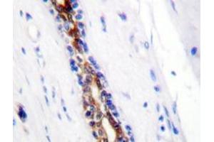 Immunohistochemistry analyzes of IRAK1 antibody in paraffin-embedded human breast carcinoma tissue. (IRAK1 Antikörper)