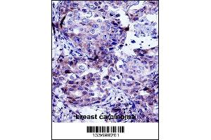 CTTN Antibody immunohistochemistry analysis in formalin fixed and paraffin embedded human breast carcinoma followed by peroxidase conjugation of the secondary antibody and DAB staining. (Cortactin Antikörper  (AA 273-302))