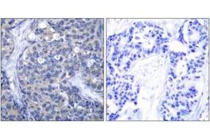 Immunohistochemistry analysis of paraffin-embedded human breast carcinoma tissue, using ZAP-70 (Ab-319) Antibody.