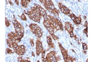 Formalin-fixed, paraffin-embedded human Breast Carcinoma stained with HER-2 Monospecific Mouse Monoclonal Antibody (ERBB2/3093). (ErbB2/Her2 Antikörper  (AA 311-462))