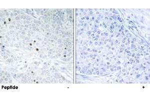Immunohistochemistry analysis of paraffin-embedded human breast carcinoma tissue, using TP53INP2 polyclonal antibody . (TP53INP2 Antikörper)