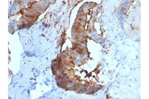Formalin-fixed, paraffin-embedded human Renal Cell Carcinoma stained with Cathepsin D Mouse Monoclonal Antibody (CTSD/2781). (Cathepsin D Antikörper  (AA 104-250))