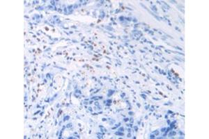 IHC-P analysis of Human Rectum Cancer Tissue, with DAB staining. (MUC2 Antikörper  (AA 5075-5179))