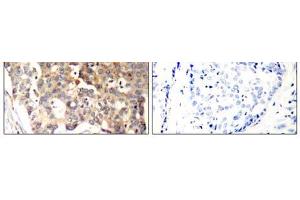 Immunohistochemical analysis of paraffin-embedded human breast carcinoma tissue, using SHP-1 (Ab-536) antibody (E021318). (SHP1 Antikörper)
